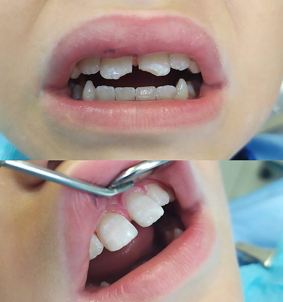 Скол переднего зуба
